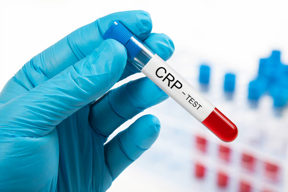 L'analyse du taux de CRP "crp prise de sang" (protéine C-réactive) est une méthode courante pour évaluer l'inflammation dans le corps.